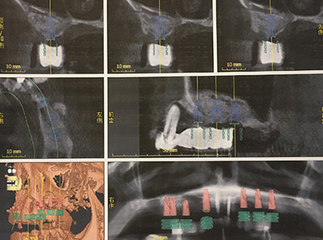 implant